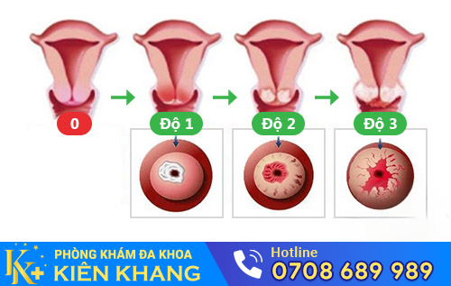 Hình ảnh bệnh viêm lộ tuyến cổ tử cung qua từng giai đoạn