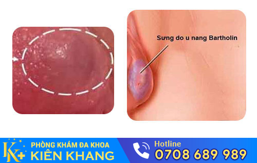 Viêm tuyến Bartholin