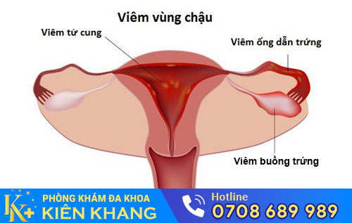 Viêm vùng chậu