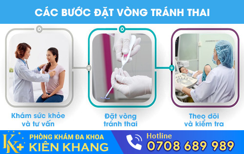 Các bước đặt vòng tránh thai