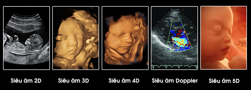 các hình thức siêu âm