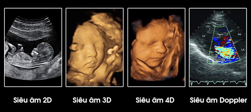 các loại siêu âm thai