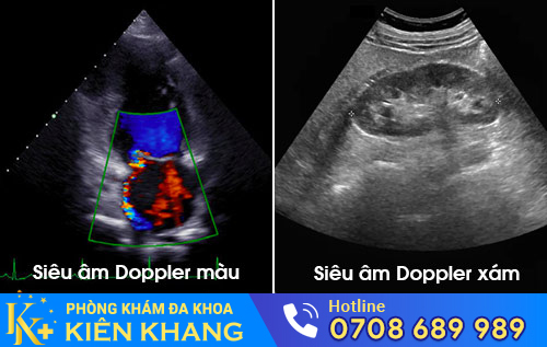 2 loại hình siêu âm Dopper thai