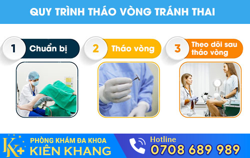 Quy trình tháo vòng tránh thai