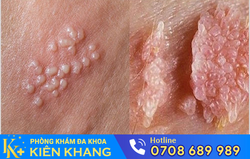 Bệnh chào mào hoa khế là bệnh gì?