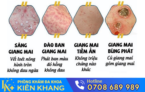 Bệnh giang mai qua các giai đoạn
