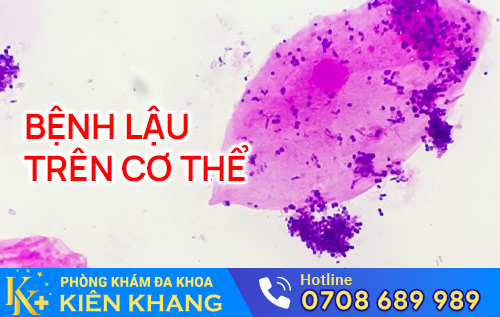 benh lau tren co the con nguoi