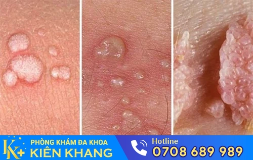 benh mong ga sui mao ga