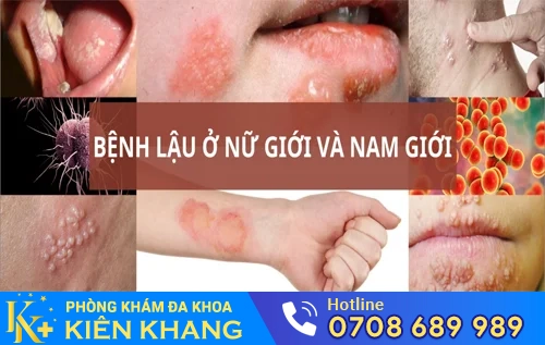 benh no bo benh lau la gi