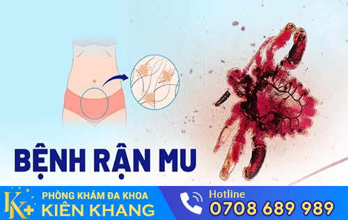 Thuốc hỗ trợ điều trị rận mu hiện nay