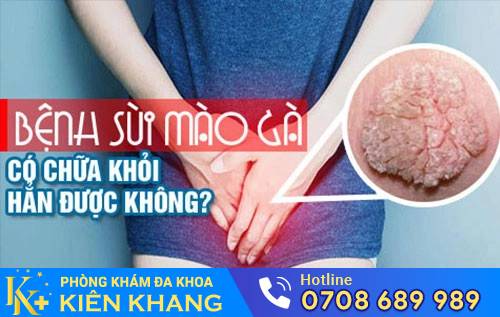 Sùi mào gà tái phát hay không?