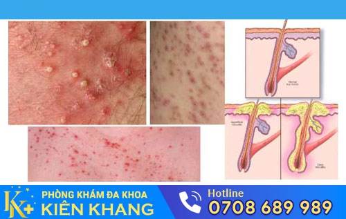 Bệnh viêm nang lông