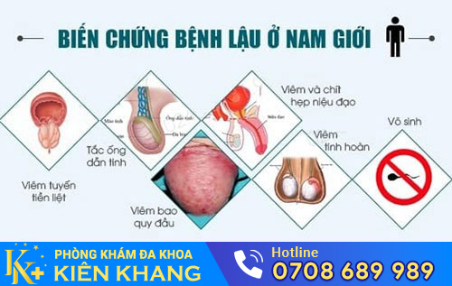 Biến chứng của bệnh lậu ở nam giới