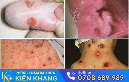 bien chung nguy hiem cua benh giang mai