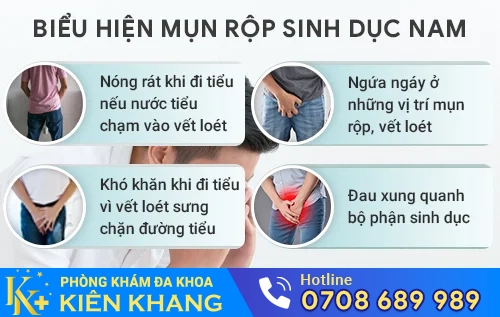 bieu hien benh mun rop sinh duc nam gioi