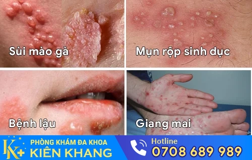 cac benh lay qua duong tinh duc