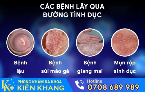cac benh lay qua duong tinh duc