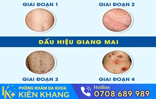 cac giai doan benh giang mai