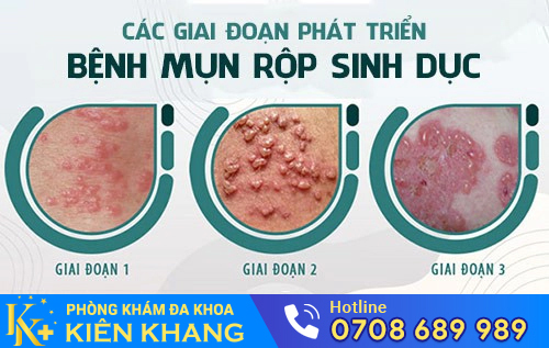 Biểu hiện mụn rộp sinh dục ở nữ