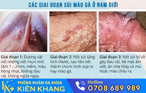 Sùi mào gà dương vật