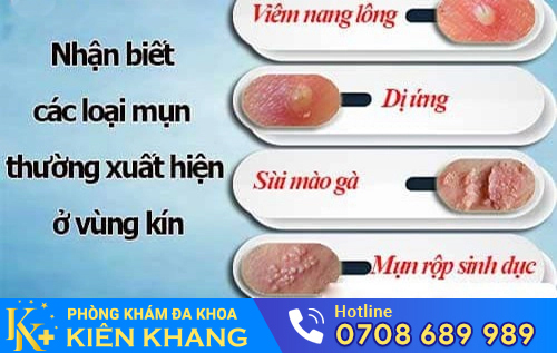 Thịt thừa vùng kín là dấu hiệu của nhiều bệnh lý nguy hiểm
