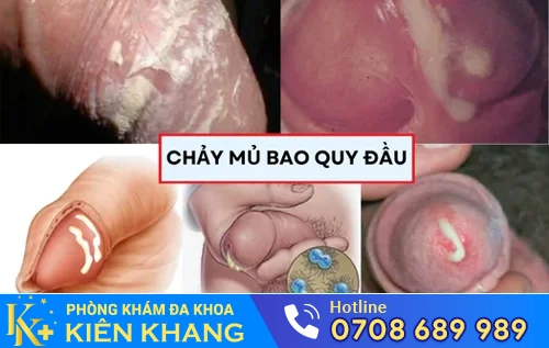 dau hieu bao quy dau chay mu