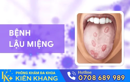 dau hieu nhan biet benh lau o mieng