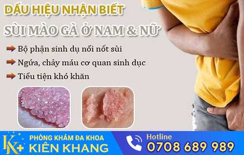 Bệnh sùi mào gà
