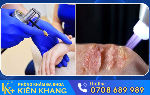 Đốt sùi mào gà