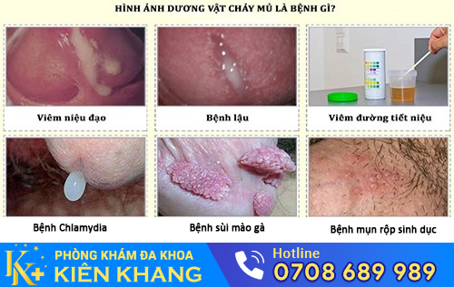 Tiểu ra mủ có thể là dấu hiệu của bệnh lậu