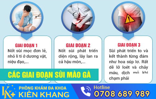 Hình ảnh bệnh nhân bị sùi mào gà ở dương vật