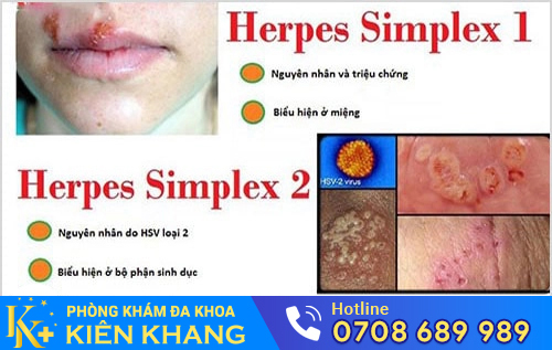 Virus HSV gây mụn rộp sinh dục gồm 2 loại: Type 1 và 2