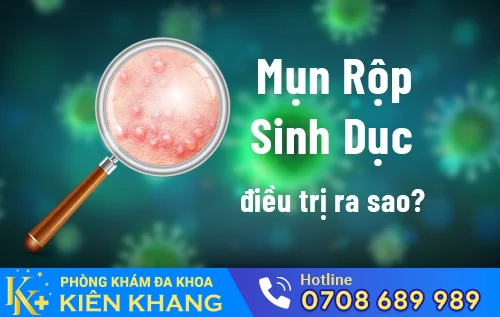 mun rop sinh duc dieu tri ra sao
