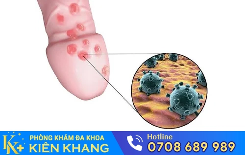 mun rop sinh duc o nam gioi