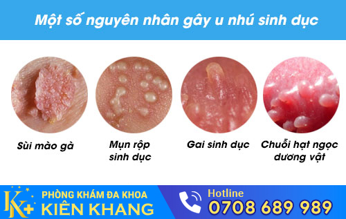 Một số nguyên nhân gây u nhú sinh dục