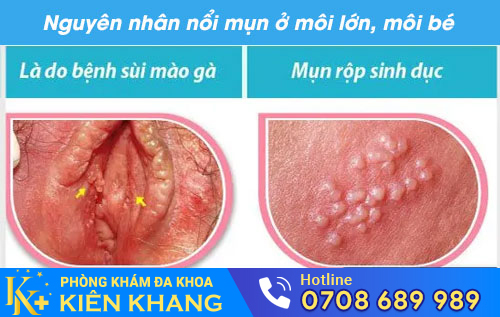 Nguyên nhân gây nổi mụn ở môi lớn, môi bé