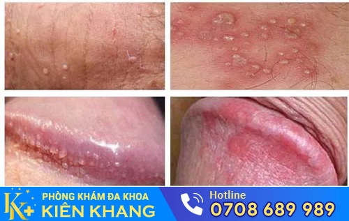 nhiem khuan sinh san nam gioi