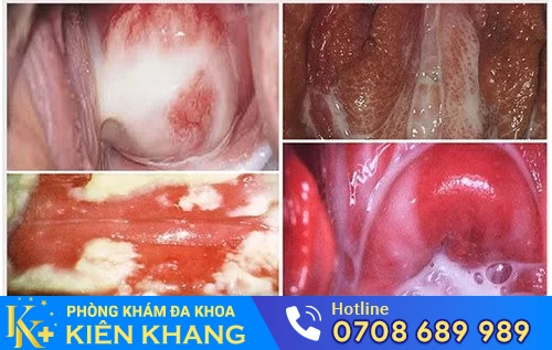 nhiem khuan sinh san nu gioi