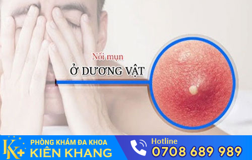 Nổi mụn ở dương vật