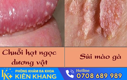 Phân biệt chuỗi hạt ngọc dương vật và sùi mào gà