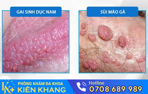 Biểu hiện gai sinh dục và sùi mào gà