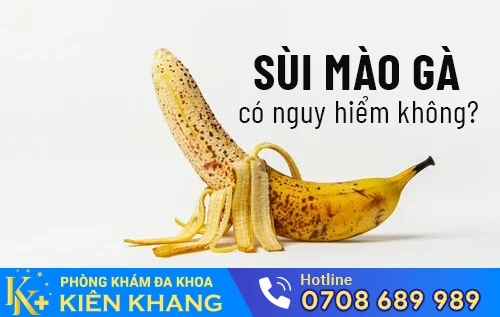 sui mao ga co nguy hiem khong