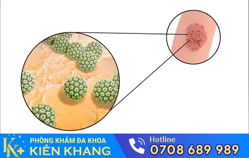 sui mao ga kho chua tri