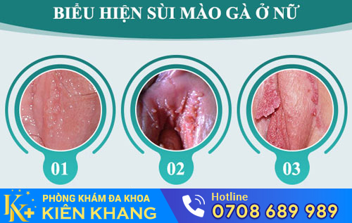 Sùi mào gà ở âm đạo