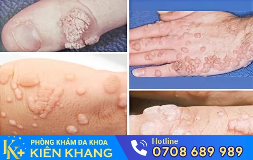 sui mao ga o chan tay