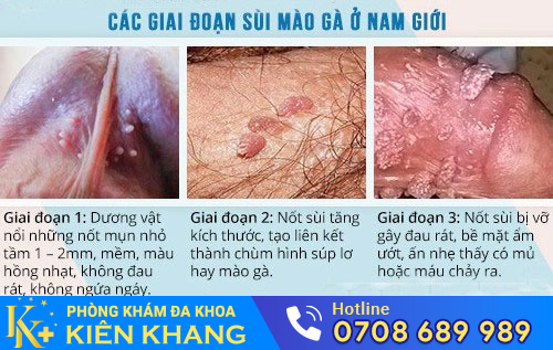 Sùi mào gà ở dương vật