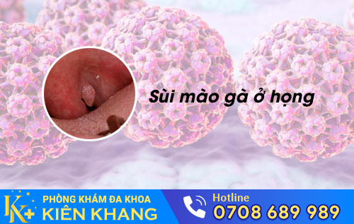 Sùi mào gà ở họng