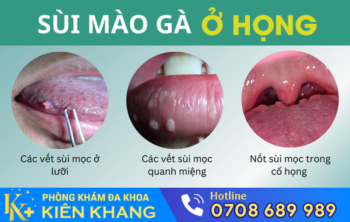 Sùi mào gà ở họng