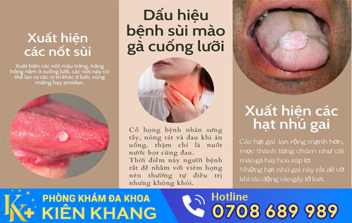 Hình ảnh sùi mào gà ở lưỡi