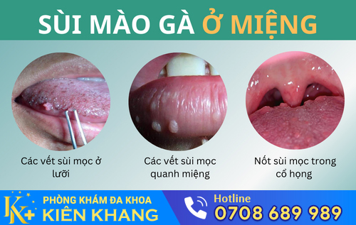 Sùi mào gà ở miệng